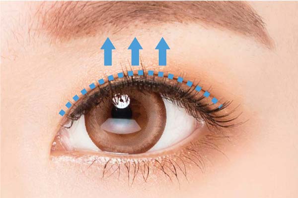 見開き拡大術（眼瞼下垂術）の施術