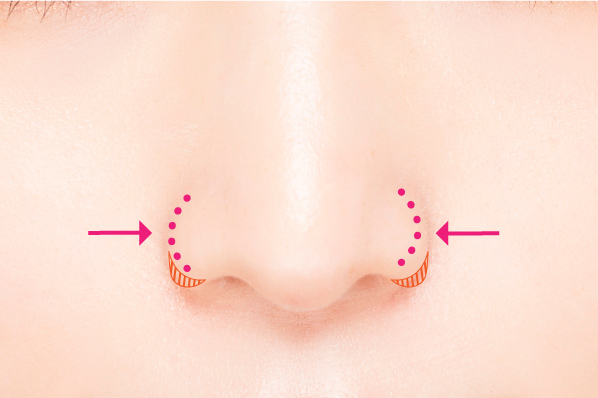 鼻翼縮小術（小鼻を小さく、鼻の穴を小さく）