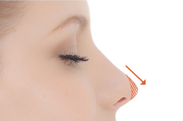 鼻中隔延長術（鼻先を伸ばす）