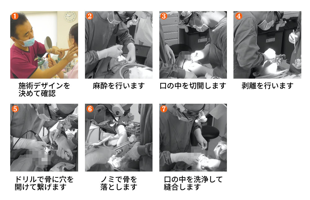 エラ削り手術の流れ