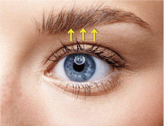 見開き拡大術（経結膜的眼瞼下垂術　けいけつまくてきがんけんかすいじゅつ）