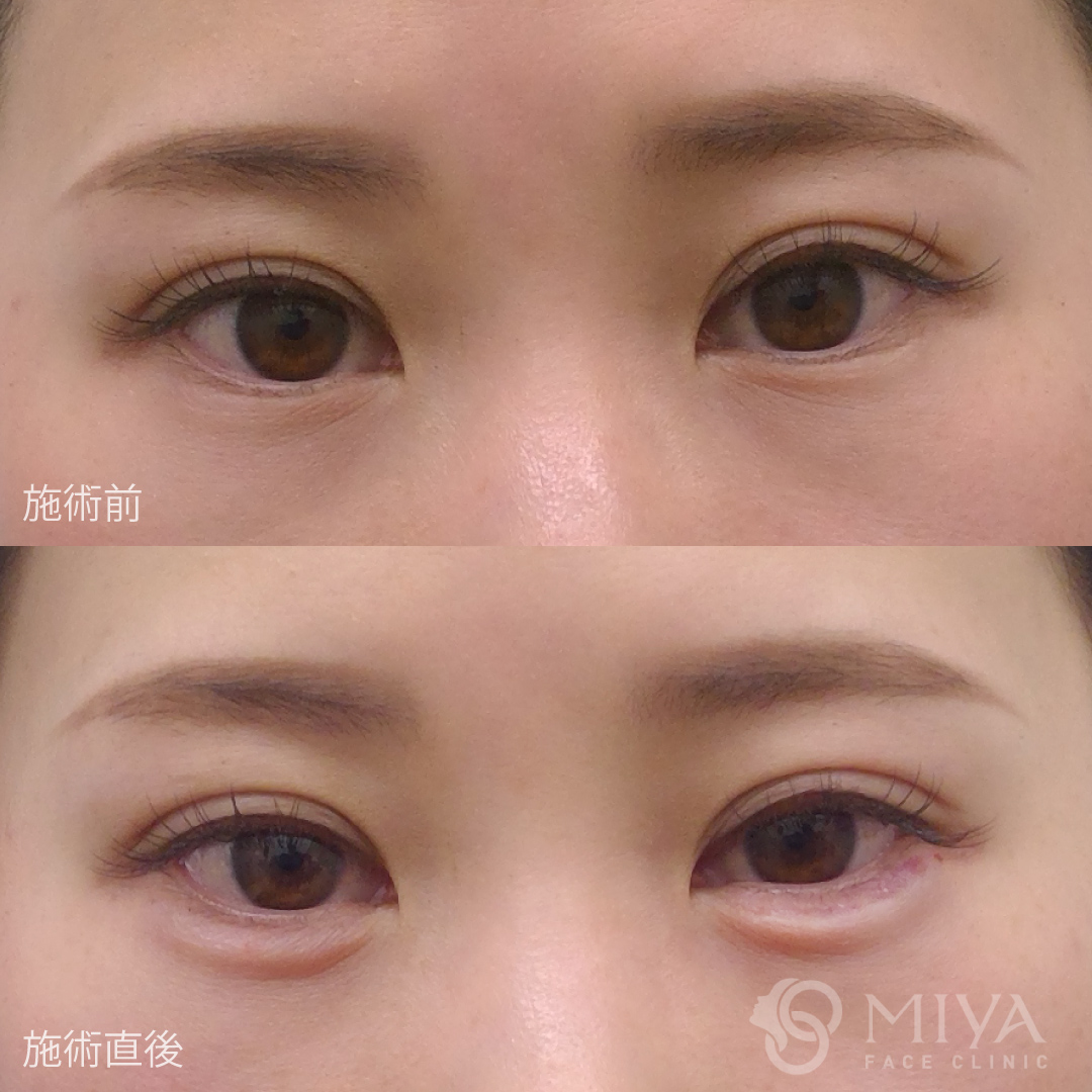 涙袋ヒアルロン酸 大阪 難波で美容整形外科 美容皮膚科ならmiyaフェイスクリニック