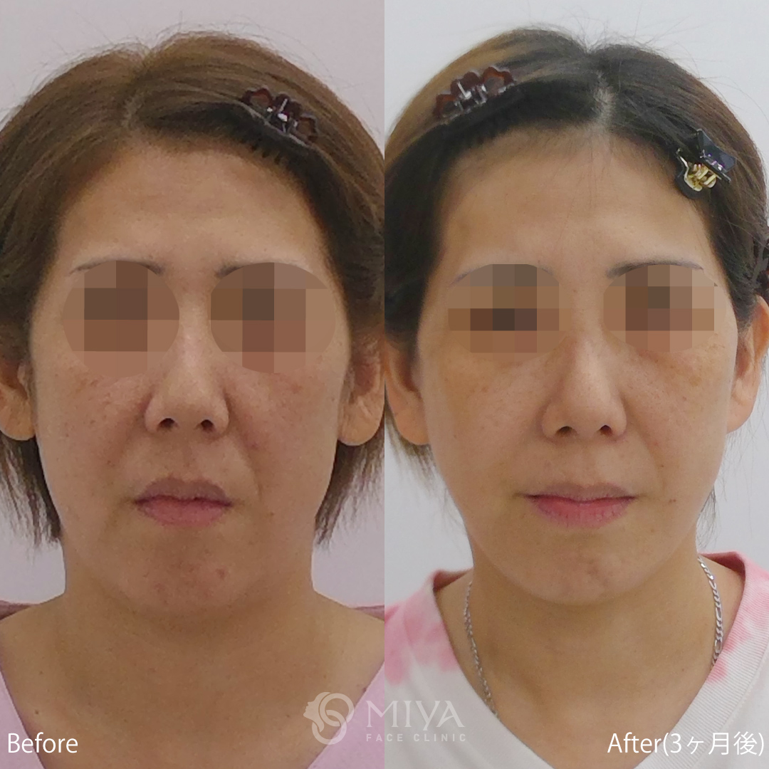 顔のリフトアップ手術の紹介 大阪 難波で美容整形外科 美容皮膚科ならmiyaフェイスクリニック