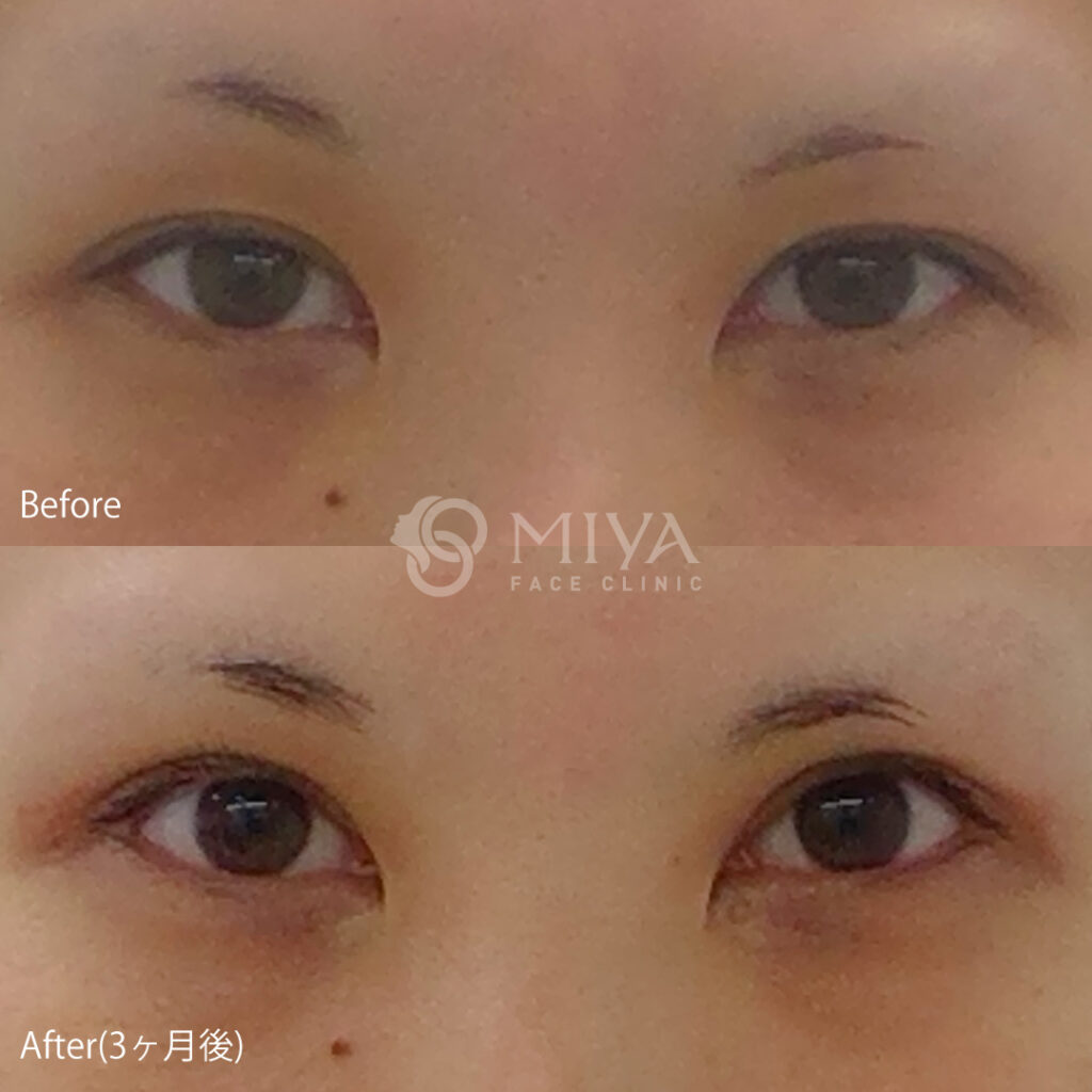 眼瞼下垂 見開き拡大手術 皮膚側 について 大阪 難波で美容整形外科 美容皮膚科ならmiyaフェイスクリニック