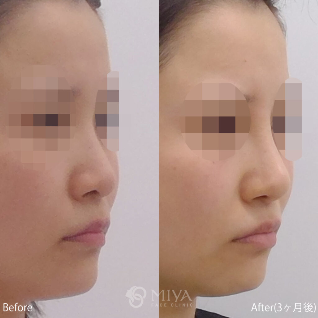 隆鼻術 鼻プロテーゼ 症例画像