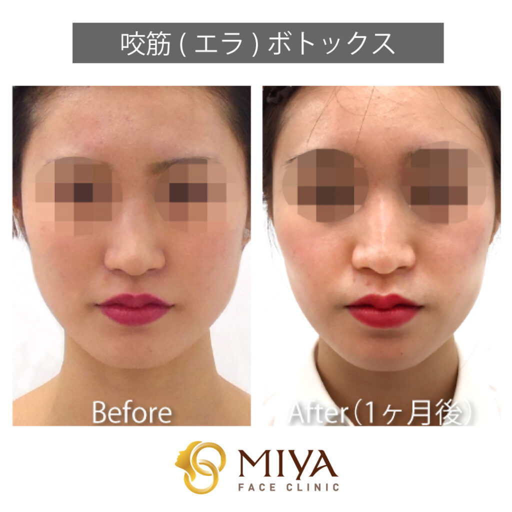 9月限定 ボトックス ボツラックス15 Off 大阪 難波で美容整形外科 美容皮膚科ならmiyaフェイスクリニック