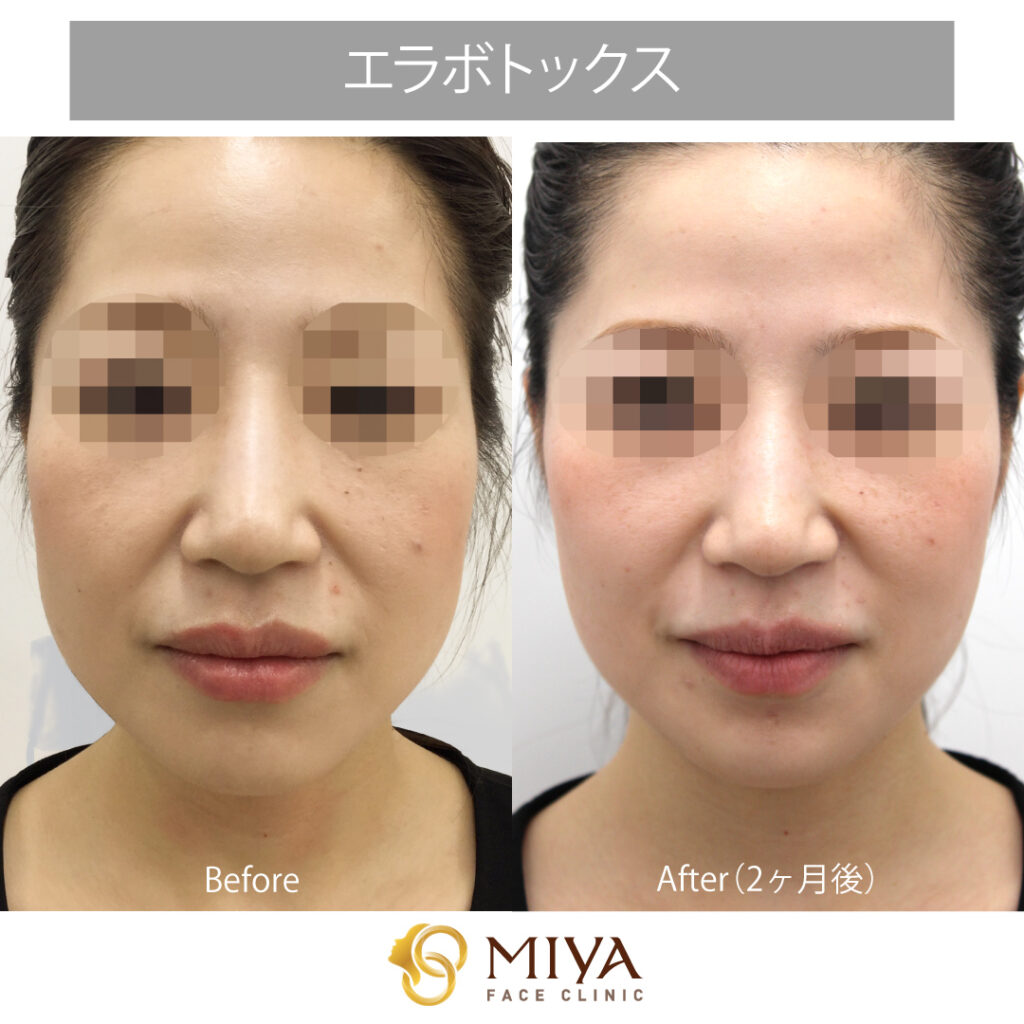 咬筋 エラ ボトックス症例写真 大阪 難波で美容整形外科 美容皮膚科ならmiyaフェイスクリニック