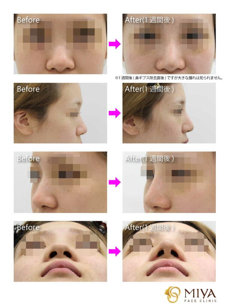 鼻の整形の症例