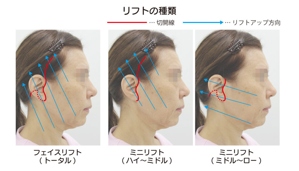 フェイスリフト 大阪 難波で美容整形外科 美容皮膚科ならmiyaフェイスクリニック