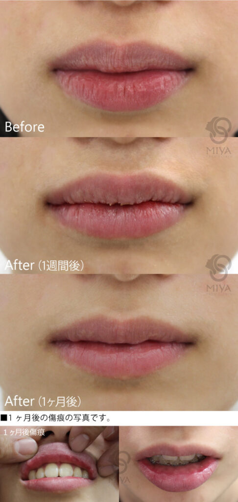口唇縮小術 唇を薄く 大阪 難波で美容整形外科 美容皮膚科ならmiyaフェイスクリニック