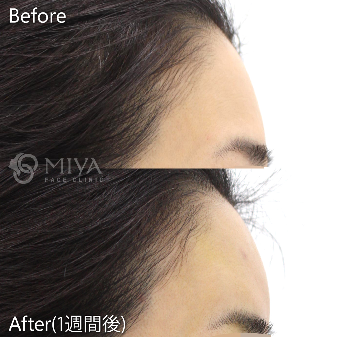 ヒアルロン酸注入で丸みのあるキレイな額へ 大阪 難波で美容整形外科 美容皮膚科ならmiyaフェイスクリニック