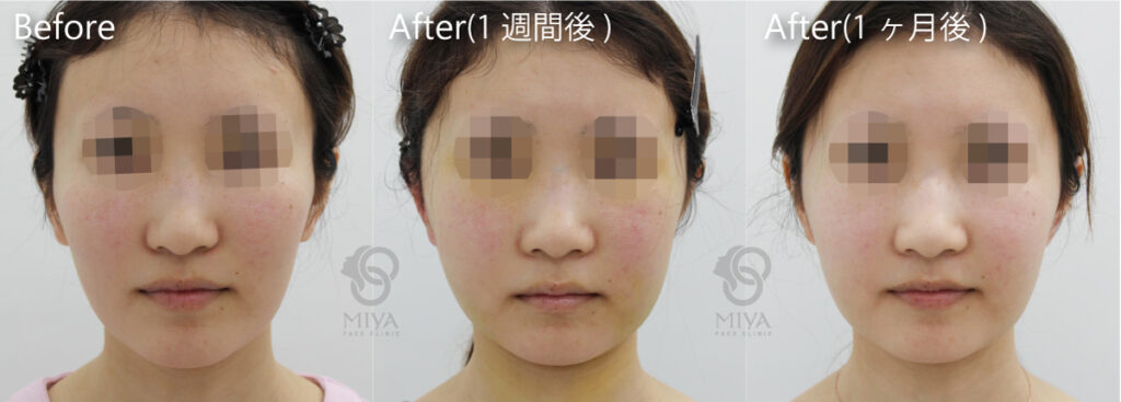 究極の小顔整形 頬骨削り 頬骨形成術 とは 症例や料金についてご紹介 大阪 難波で美容整形外科 美容皮膚科ならmiyaフェイスクリニック