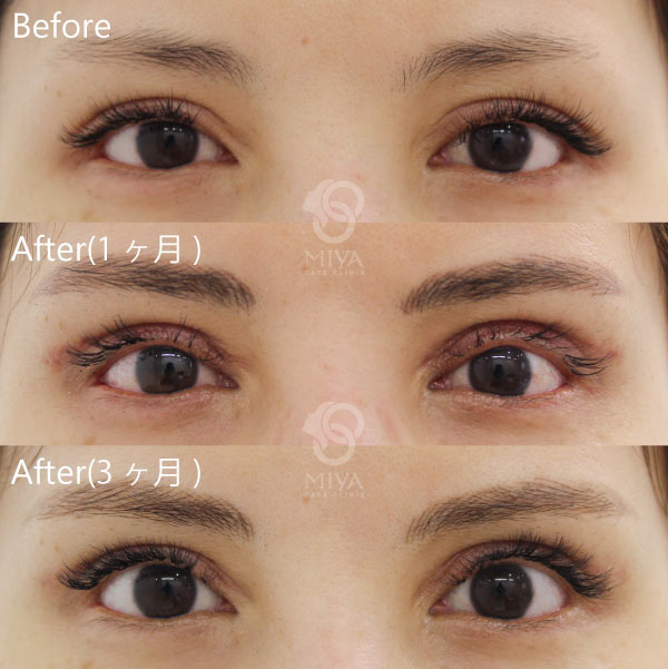 目もとの症例 大阪 難波で美容整形外科 美容皮膚科ならmiyaフェイスクリニック