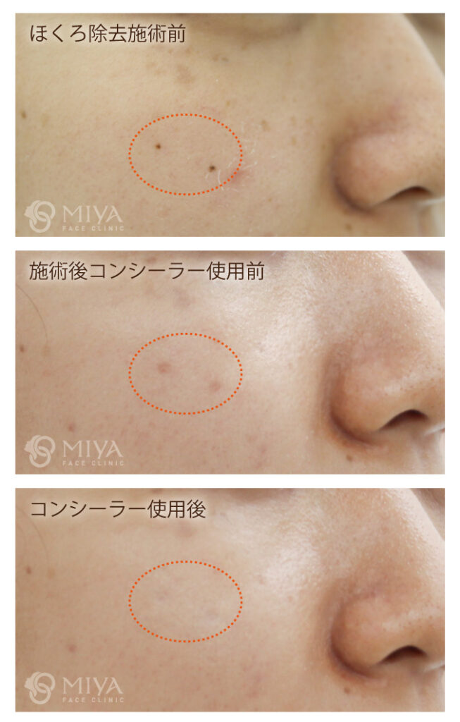 レーザー治療後の色素沈着について 大阪 難波で美容整形外科 美容皮膚科ならmiyaフェイスクリニック