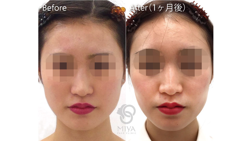 エラボトックス 大阪 難波で美容整形外科 美容皮膚科ならmiyaフェイスクリニック