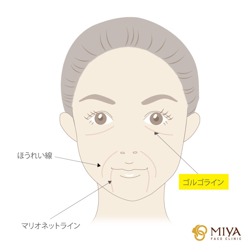 ゴルゴライン ミッドチークライン 大阪 難波で美容整形外科 美容皮膚科ならmiyaフェイスクリニック