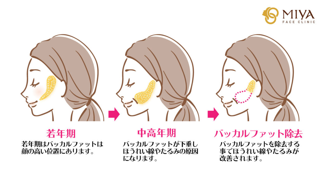 バッカルファット除去 大阪 難波で美容整形外科 美容皮膚科ならmiyaフェイスクリニック
