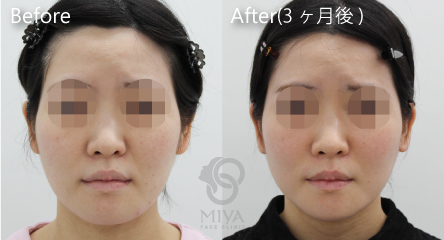 しわ たるみ フェイスリフトの症例 大阪 難波で美容整形外科 美容皮膚科ならmiyaフェイスクリニック