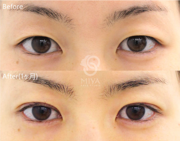 目もとの症例 大阪 難波で美容整形外科 美容皮膚科ならmiyaフェイスクリニック