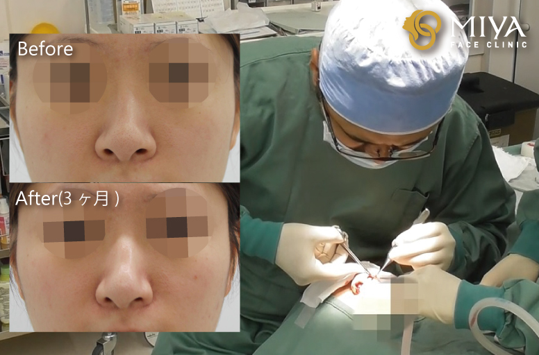 鼻を小さくする美容整形の手術方法は 大阪 難波で美容整形外科 美容皮膚科ならmiyaフェイスクリニック