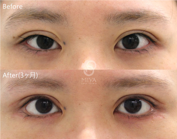 グラマラスライン 眼瞼下垂 症例