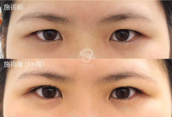 目もとの症例 大阪 難波で美容整形外科 美容皮膚科ならmiyaフェイスクリニック