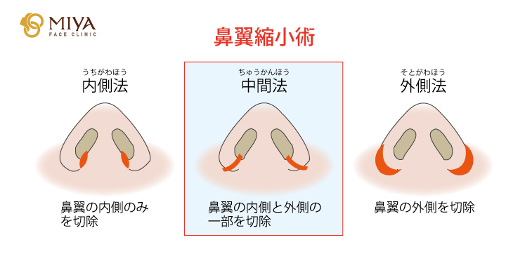 中間法 鼻翼縮小 大阪 難波で美容整形外科 美容皮膚科ならmiyaフェイスクリニック