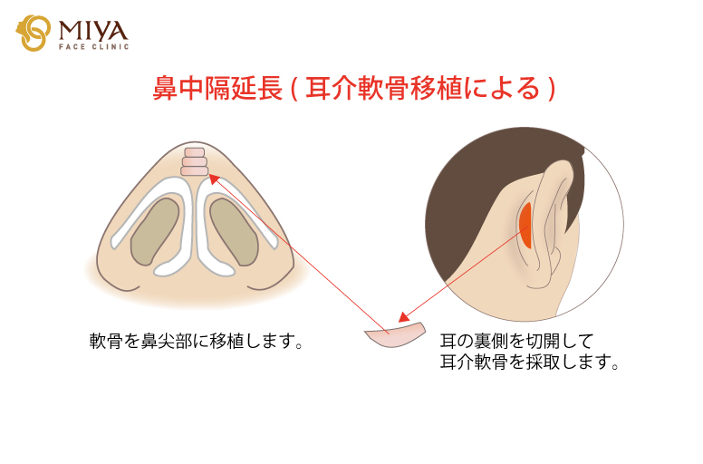 鼻中隔延長術(耳介軟骨移植による)の解説イラスト