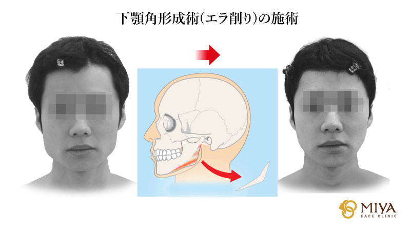 下顎角形成術(エラ削り)の施術