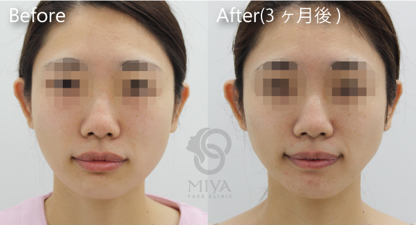 顎 エラ 輪郭 小顔の症例 大阪 難波で美容整形外科 美容皮膚科ならmiyaフェイスクリニック