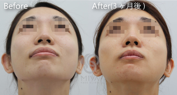 顎 エラ 輪郭 小顔の症例 大阪 難波で美容整形外科 美容皮膚科ならmiyaフェイスクリニック