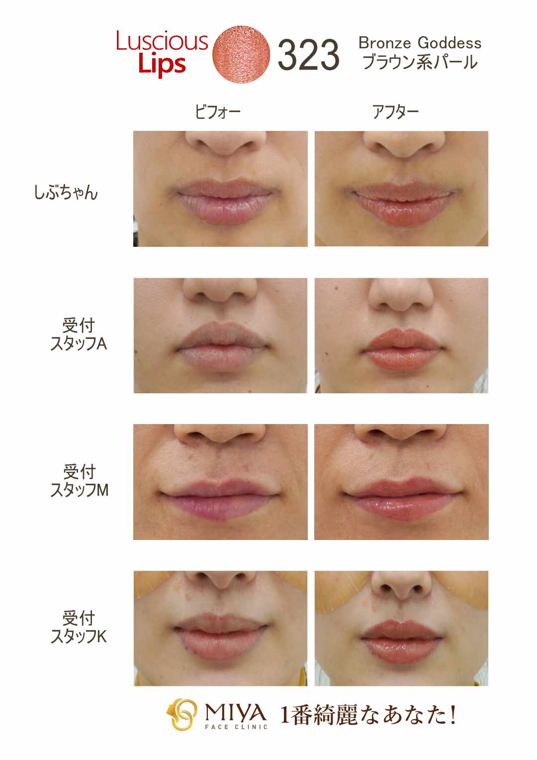 ラシャスリップスお色味紹介⑤ | 大阪・難波で美容整形外科・美容皮膚