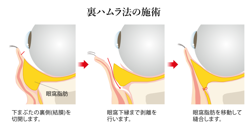 経結膜的眼窩脂肪移動術(裏ハムラ法)の施術とは