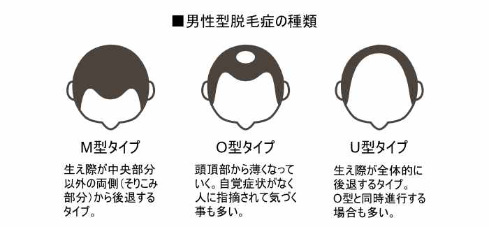 男性型脱毛症(AGA)の種類