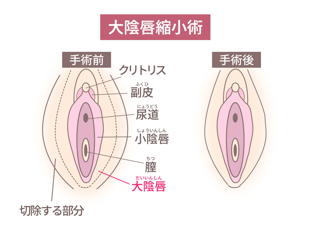 大陰唇縮小術(だいいんしんしゅくしょうじゅつ)