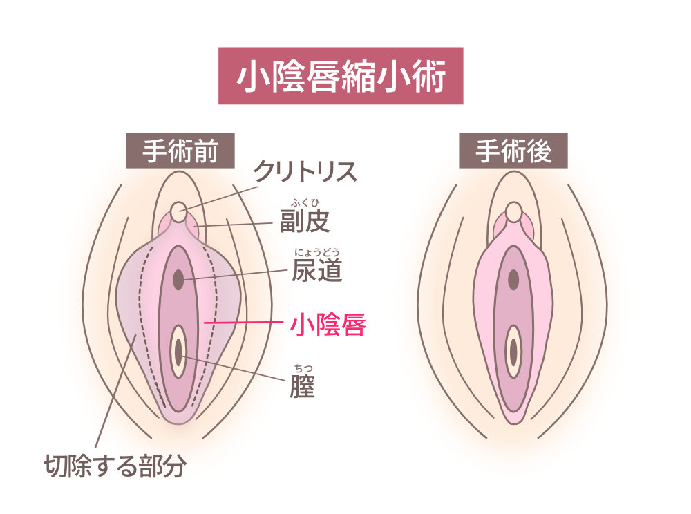 小陰唇縮小術(しょういんしんしゅくしょうじゅつ)