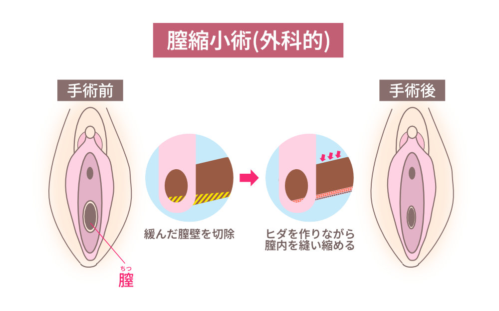 膣縮小術(外科的)