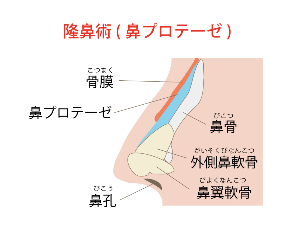 隆鼻術(鼻プロテーゼ説明)