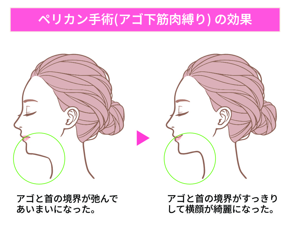 ペリカン手術の効果