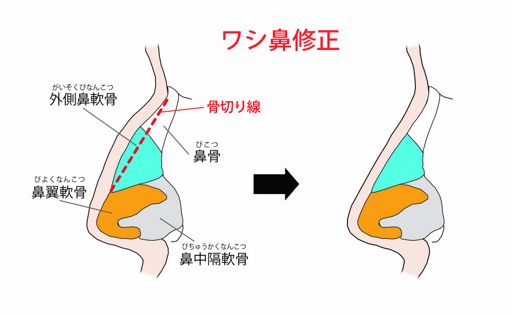 ワシ鼻修正