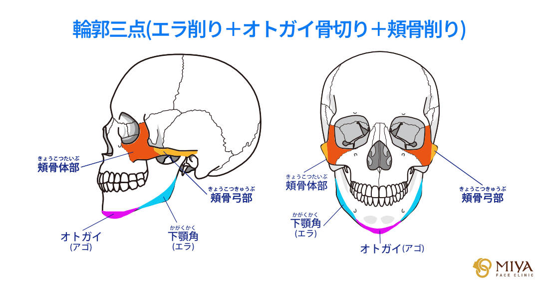 輪郭三点手術とは