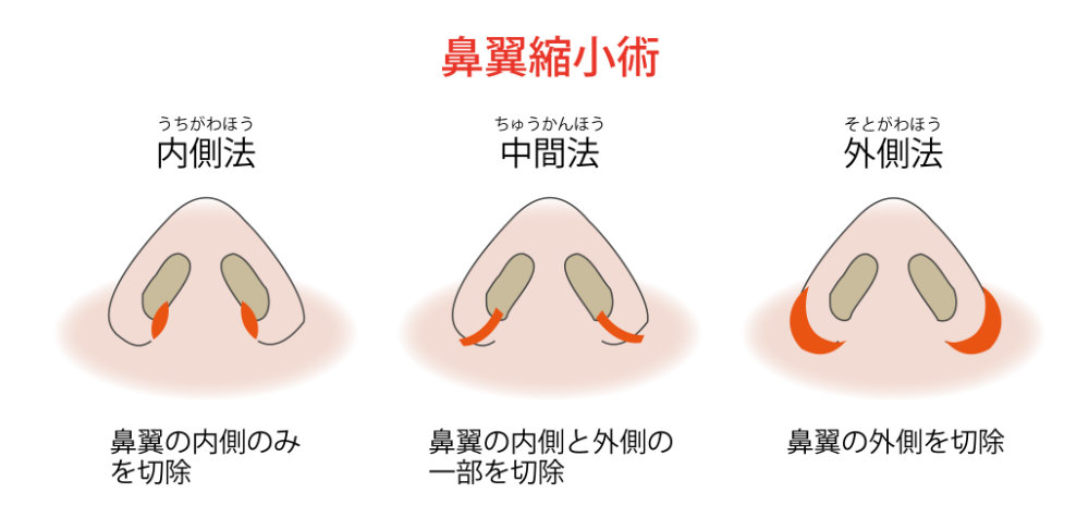 鼻翼縮小の種類