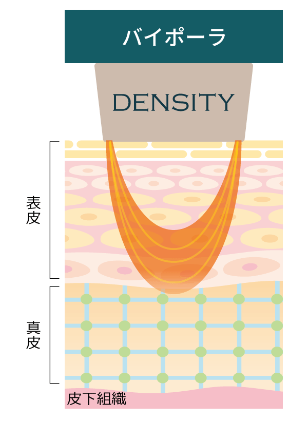 デンシティ バイポーラ
