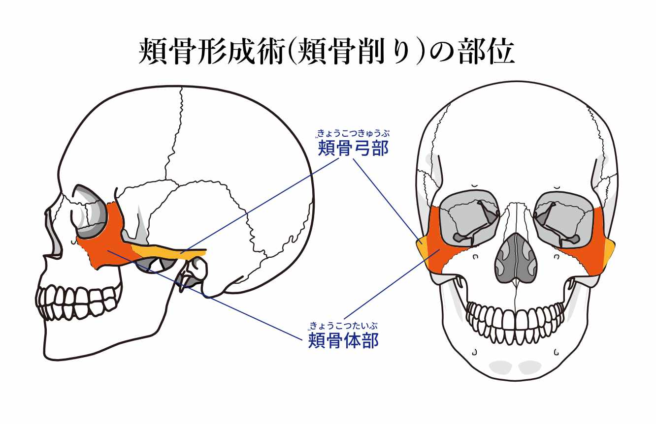 頬骨削りの部位