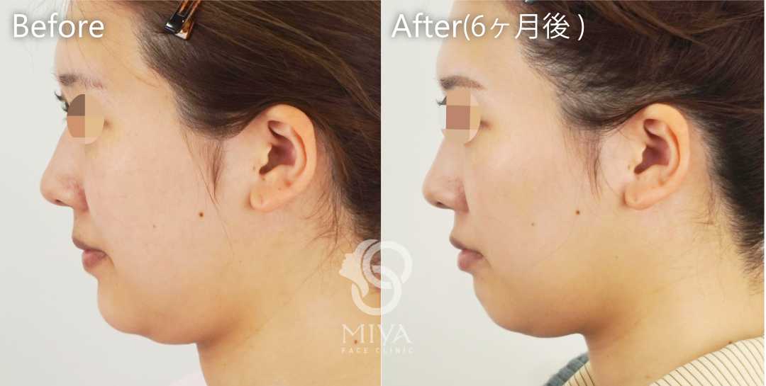 脂肪吸引 症例
