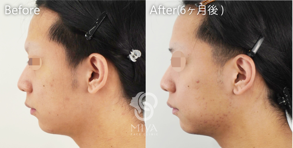 脂肪吸引 症例