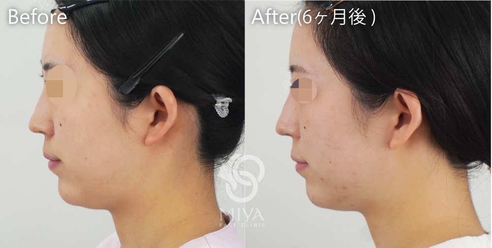 脂肪吸引 症例