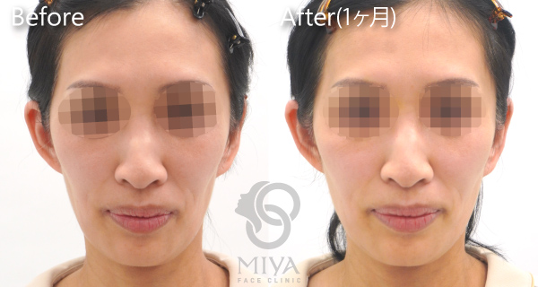 スレッドリフト アプトス 症例