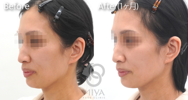 スレッドリフト アプトス 症例