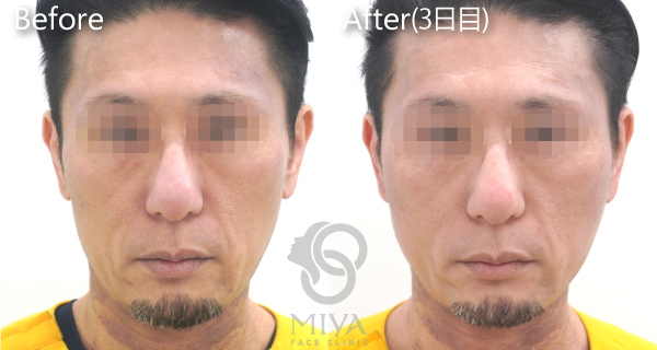 スレッドリフト アプトス 症例